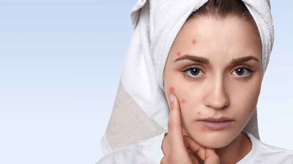 Skincare Essentials for Acne Prone Skin Best Products Ingredients to Use and Avoid